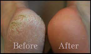 They may be very dry, there may be an infection, or you may have athlete's foot. Baby Foot Chemical Peels For The Feet Sei Bella Med Spa
