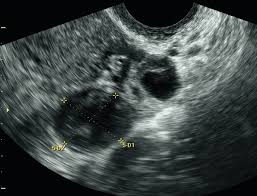 Image result for corpus luteum sonography)