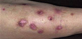 Image result for Neurotic Excoriation