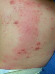 Image result for skin rash similar to scabies