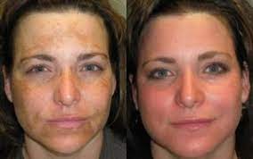 While people who've had laser hair removal may want to show off their smooth legs or bikini line in the summer months, sunlight can cause unsightly discoloration on treated skin, according to. These Benefits Of Laser Hair Removal Will Amaze You