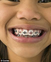If you're wearing a dracula costume, you'll want to add fake blood to your teeth; Fake Braces Trend Is A New Status Symbol For Asian Teenagers But Could They Kill Wearers Daily Mail Online