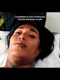 Karina Torres Laser En Cara