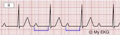 Image result for PR Interval