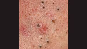 Accutane is indicated for the treatment of severe recalcitrant nodular acne. Nodular Acne Symptoms Treatment Scarring And More