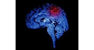 Deriva solitamente da danneggiamento dei vasi sanguigni dovuto ipertensione Come Nasce Un Emorragia Cerebrale La Repubblica