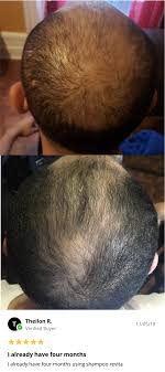 Revita and spectral dnc for hair loss. These Two Products Will Enhance Minoxodil Results To Regrow Hair Ds Healthcare Group