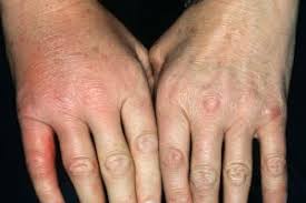287 :215 doi you are going to email the following finger sepsis. Cellulitis Nidirect