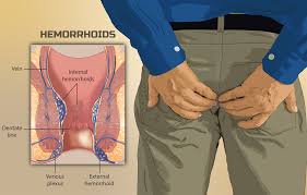 Image result for Hemorrhoid
