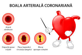 Una din patru persoane moare din cauza bolilor cardiovasculare. Boala Arteriala Coronariana Cardiopatia Ischemica Reginamaria Ro