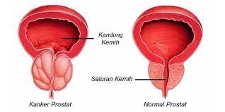 Kanker prostat biasanya tidak menimbulkan gejala apapun sampai kanker telah tumbuh . Kanker Prostat Adalah Penyakit Kanker Nomor 2 Pada Pria Deherba Com
