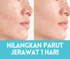Jika ingin menghilangkan jerawat dalam waktu yang cepat, maka cara menghilangkan jerawat dengan es batu bisa menjadi solusinya. 9 Cara Nak Hilangkan Parut Jerawat Dalam Masa 1 Hari 2021 Sihat Me