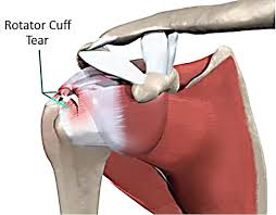 The shoulder is made up of three bones: Rotator Cuff Tear Hinterland Physio