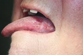 Image result for lichen planus on tongue)
