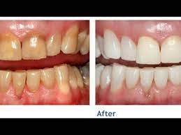 We did not find results for: How To Whiten Teeth At Home In 3 Minutes Without Any Harsh Chemicals Youtube