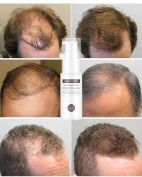 It is consume lots of vitamin e, vitamin c and vitamin b. China Hair Growth Essential Oil Plant Essence Prevents Hair Loss Nourishing Rapid Hair Growth Suitable Men Women China Hair Growth Essential Oil And Hair Growth Fiuid Price
