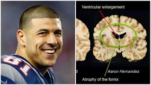An experimental brain scan can now detect abnormal proteins in the brains of living former nfl they found that tau — the abnormal protein that forms after the destruction of normal brain matter cte is a neurodegenerative disease found most commonly in athletes with a history of repetitive. Aaron Hernandez Cte Photos Show Severe Brain Damage Heavy Com