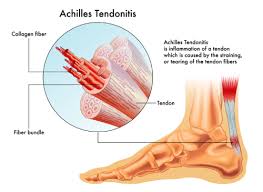 An achilles tendon rupture can be confirmed by an mri or ultrasound. How To Overcome Achilles Tendonitis Using Chiropractic