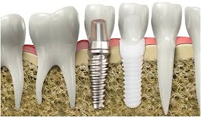 Cdg or the cosmetic dentistry grants organization provides over $1 million dollars each year for cosmetic dental procedures such as dental implants. Zirconia Promises Superior Strength And Aesthetics In Dental Implants Dentistry Today