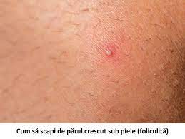 Deşi utilizarea lamei de ras pare să fie principala cauză a firelor crescute sub piele, nici dacă foloseşti epilatorul sau ceara nu eşti scutită de acest neajuns. Libertatea Pentru Femei Ai Fire De PÄr Crescute Sub Piele AflÄ Cum PoÈi ScÄpa De Ele Prin Metode Naturale Https Goo Gl Ibefg4 Facebook