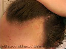 Maybe you would like to learn more about one of these? I M 17 Years Old And Wondering If My Hairline Is Receding With Photos Wrassman M D Baldingblog