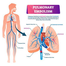 Want to learn more about it? Pulmonary Embolism Vector Illustration Labeled Lung Blood Blockage Scheme Stock Vector Illustration Of Chronic Chest 155255258