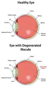 Risk Factors For Age Related Macular Degeneration