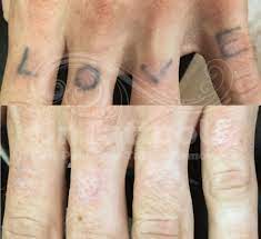 Whether Your Tattoo Was A Spontaneous Decision A Few Months Ago Or You Started Dis Tattoo Removal Laser Tattoo Removal Before And After Picosure Tattoo Removal