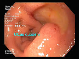 Blut im stuhl durch hämorrhoiden. Gastroenterologie Krankheitsbilder Praxis Fur Innere Medizin In Walldorf
