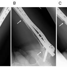41/1994 privind autorizarea plăţii cotizaţiilor la organizaţiile internaţionale interguvernamentale la care românia este parte. Pdf Salvage Reconstruction With The Masquelet Technique Following Wide Resection For Chondrosarcoma Of The Proximal Femoral Metaphysis A Case Report