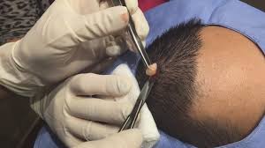 Sandra lee, posted an instagram video in which she treated a patient's two lipomas. This Cyst Blackhead Are No Match For Dr Pimple Popper Youtube