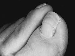 Image result for Beau lines feet