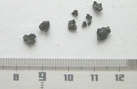 Image result for Gallstone