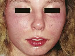 Zu den symptomen gehören grippeähnliche beschwerden und oft auch halsschmerzen. Mononucleosis Infectious Altmeyers Encyclopedia Department Dermatology