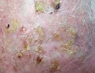 In the united states, it's estimated that doctors diagnose over 100,000 new skin cancer cases each year. Multiple Crusted Lesions On The Scalp Medicine Today