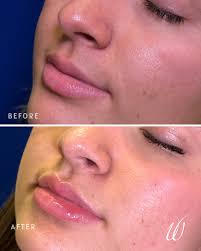 🎶"My lip gloss is poppin'…” and yours can be too 💋 BOOTOX week = NEXT  week = the best deals of the year: 💉 $100 OFF a syringe of filler 💉 Buy