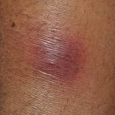 Image result for erythema nodosum