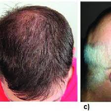 Diet pills that contain amphetamines also can cause hair loss. Pdf Evaluation Of Patients With Alopecia