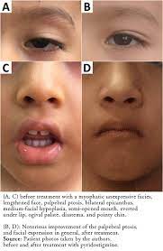 Congenital Myasthenic Syndrome Due To Rapsyn Deficiency A Case Report With A New Mutation And Compound Heterozygosity Medwave