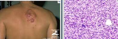 Image result for Dermatofibrosarcoma Protuberans