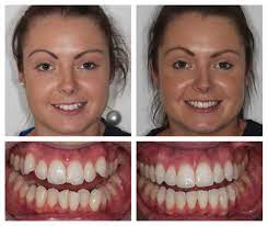With the patented inman aligner, your front teeth can be gently guided to an ideal position in a matter of weeks. Inman Aligner Braces In West Byfleet Surrey Roseneath Dental Surgery
