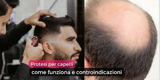 Protesi capelli uomo online della migliore qualità, i toupet uomo, gli impianti capelli che desideri, i migliori prodotti per protesi, il tutto a prezzi . Protesi Per Capelli Come Funziona E Controindicazioni