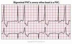 Ceufast Com Bigeminal Pvc Ekg Interpretation Nursing Ecg Interpretation Nursing Ceu