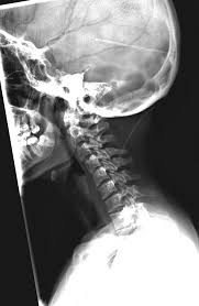 Abnormal Vp Shunt Series Radiology Case Radiopaedia Org