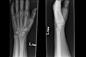 Image result for Scaphoid Bone