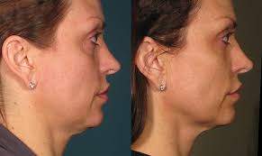 Find out how much the ultherapy skin tightening procedure costs from one of the most trusted providers in los angeles, the z center for cosmetic health. Ultherapy Fairfield Dermatology