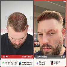 Watch Matthew Nicholas Callan who had a previous surgery in UK, sharing his  experience with us the day after his hair transplant surgery. We do  hundreds of corrections surgeries to people