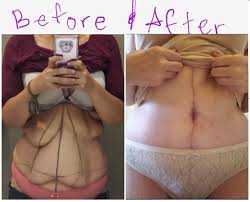 It tightens the hips and waistline unlike any other operation. Tummy Tuck In Mexico Mexico Cosmetic Center