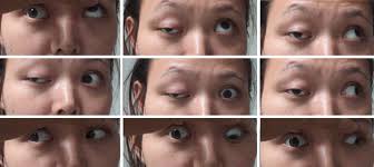 Ocular Myasthenia Gravis | Springer Nature Link