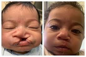 This is used mostly when a bilateral cleft lip repair has left the top lip looking thin and tight. Before And After Cleft Lip Surgery 9gag